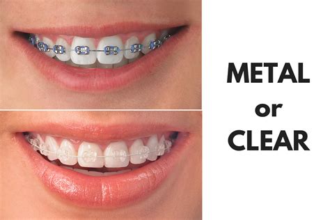 clear brackets with metal wire|replacement clear braces.